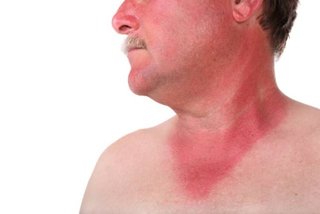 Alergia Skórna